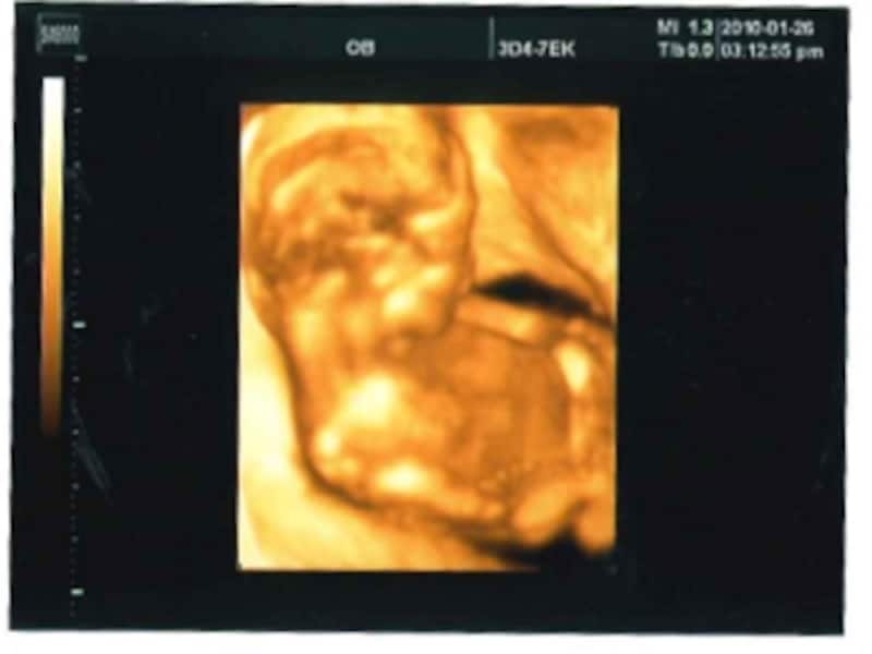 妊娠17週目（17w,十七週）の胎児のエコー写真・超音波写真