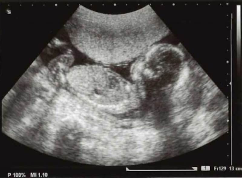 妊娠18週目エコー写真 赤ちゃんの大きさ 胎動が分かる人も 妊娠中期