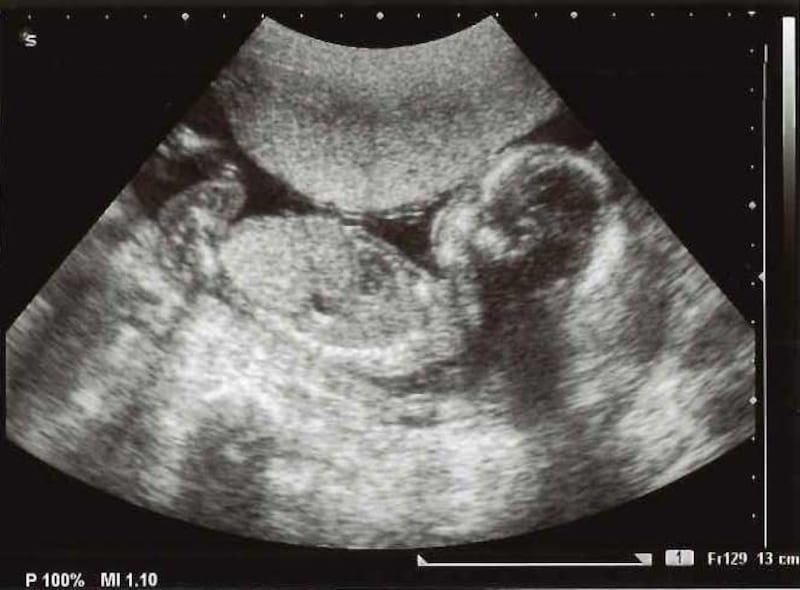 妊娠18週（18w,十八週）の胎児のエコー写真・超音波写真