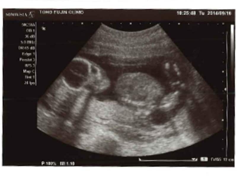 妊娠19週（19w,十九週）の胎児のエコー写真・超音波写真