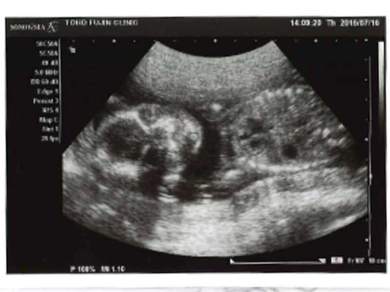 妊娠20週（20w,二十週）のエコー写真・超音波写真