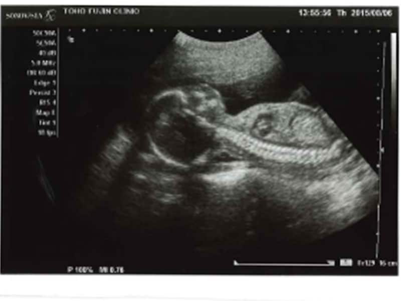 妊娠21週（21w,二十一週）胎児のエコー写真・超音波写真