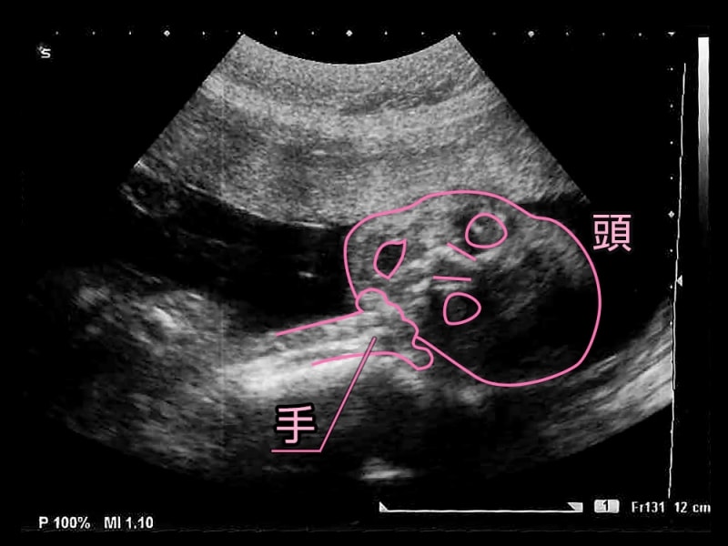 妊娠24週（24w,二十四週）胎児のエコー写真・超音波写真