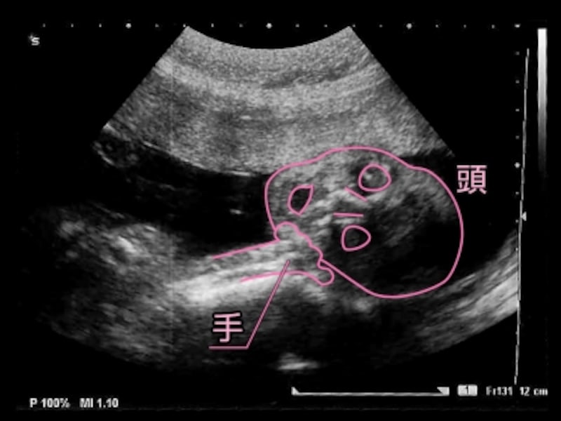 妊娠24週（24w,二十四週）胎児のエコー写真・超音波写真
