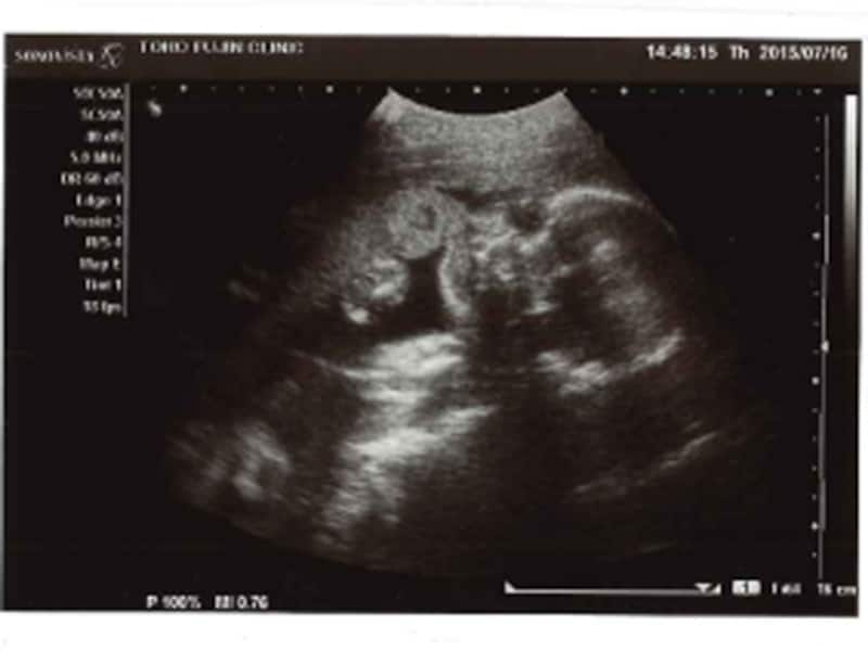 妊娠26週（26w,二十六週）胎児のエコー写真・超音波写真