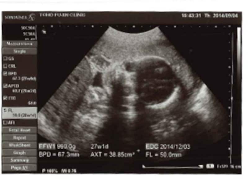 妊娠27週（27w,妊娠二十七週）胎児のエコー写真・超音波写真