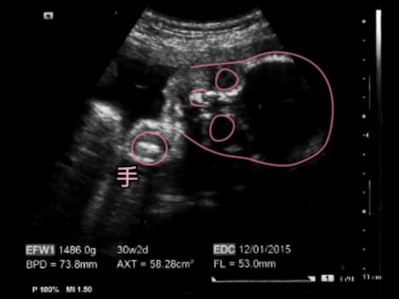 妊娠30週目（30w,妊娠三十週）、胎児のエコー写真・超音波写真