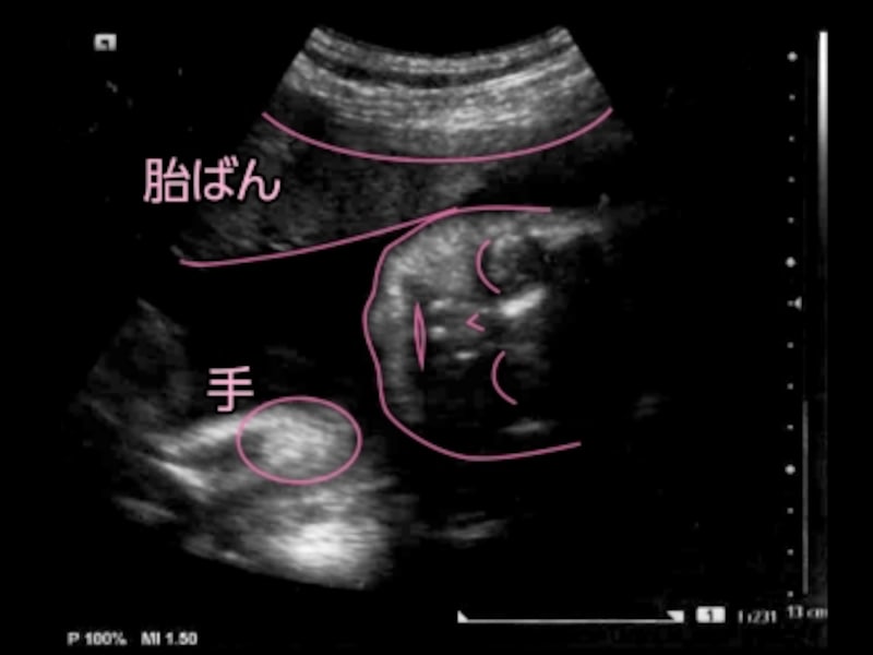 妊娠31週（31w,妊娠三十一週）の胎児のエコー写真・超音波写真