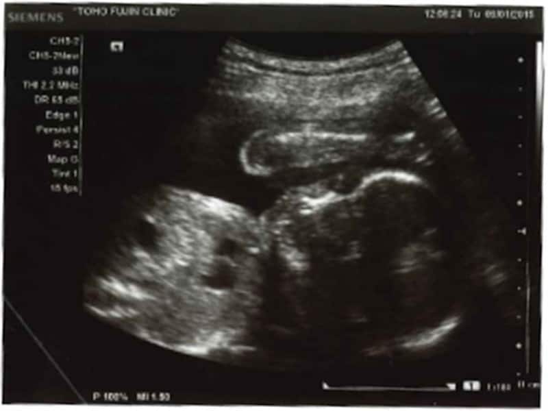 妊娠32週（32w,妊娠三十二週）の胎児のエコー写真・超音波写真