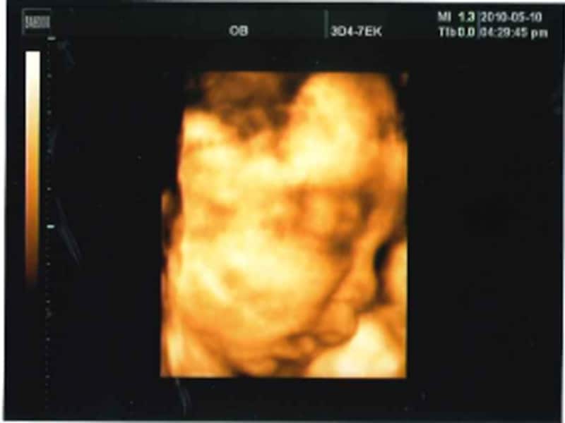 妊娠33週（33w,妊娠三十三週）の胎児のエコー写真・超音波写真