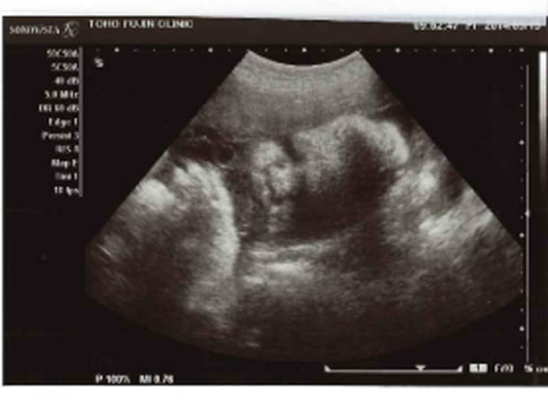 妊娠34週（34w,妊娠三十四週）の胎児のエコー写真・超音波写真