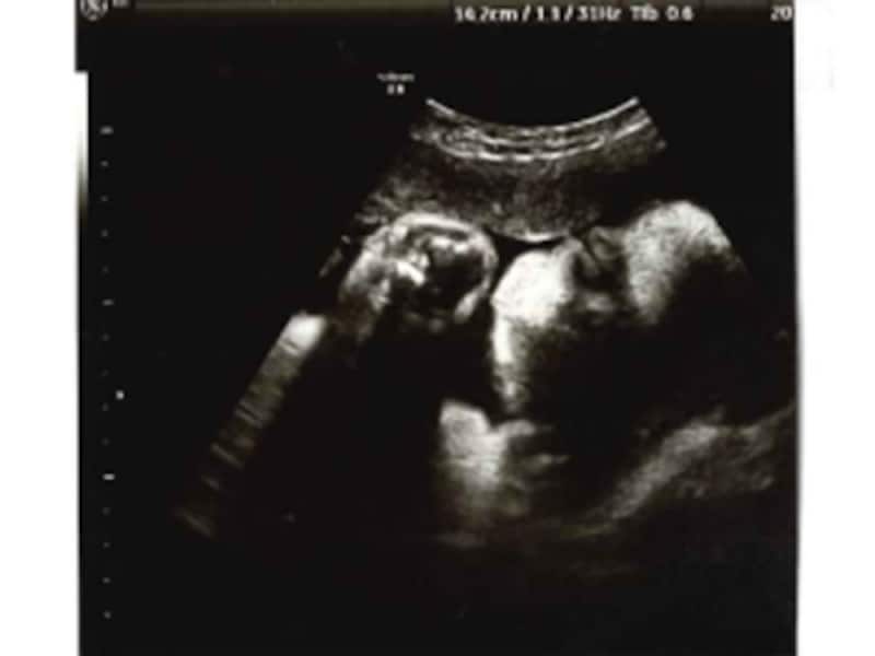 妊娠35週（35w,妊娠三十五週）の胎児のエコー写真・超音波写真