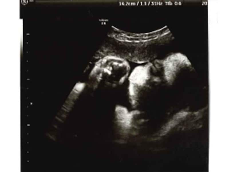 妊娠35週（35w,妊娠三十五週）の胎児のエコー写真・超音波写真