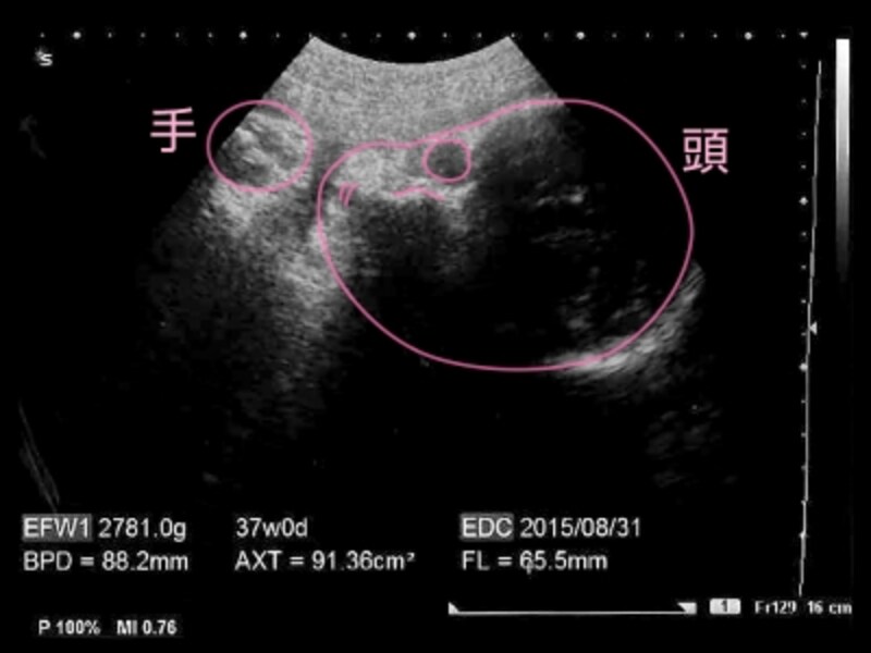 妊娠37週目,37w,妊娠三十七週の胎児のエコー写真・超音波写真