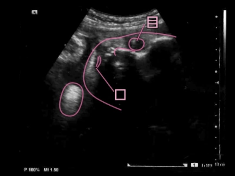 妊娠39週,39w,妊娠三十九週　胎児のエコー写真・超音波写真