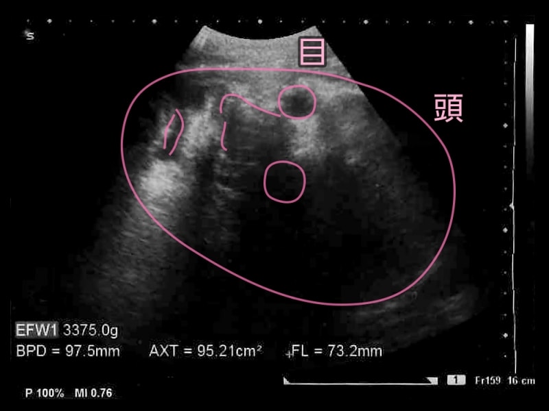 妊娠40週目,40w,妊娠四十週　胎児のエコー写真・超音波写真