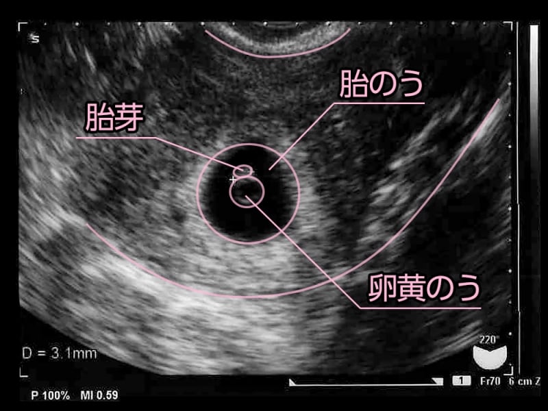 妊娠6週目（6w）の胎芽・胎嚢のエコー写真・超音波写真