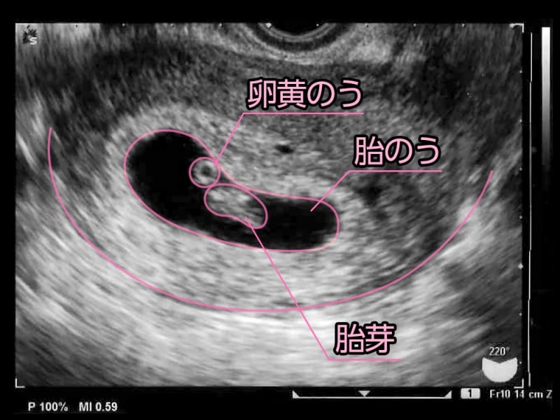 妊娠7週目（7w,妊娠七週）胎芽・胎嚢・卵黄嚢のエコー写真・超音波写真