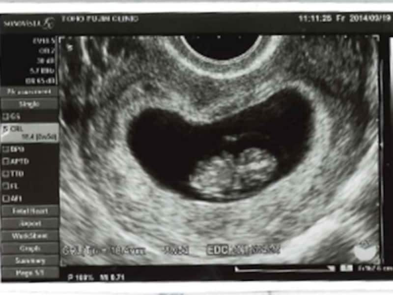 妊娠8週目（8w,妊娠八週,8w0d,8w1d,8w2d,8w3d,8w4d,8w5d,8w6d）胎児のエコー写真・超音波写真