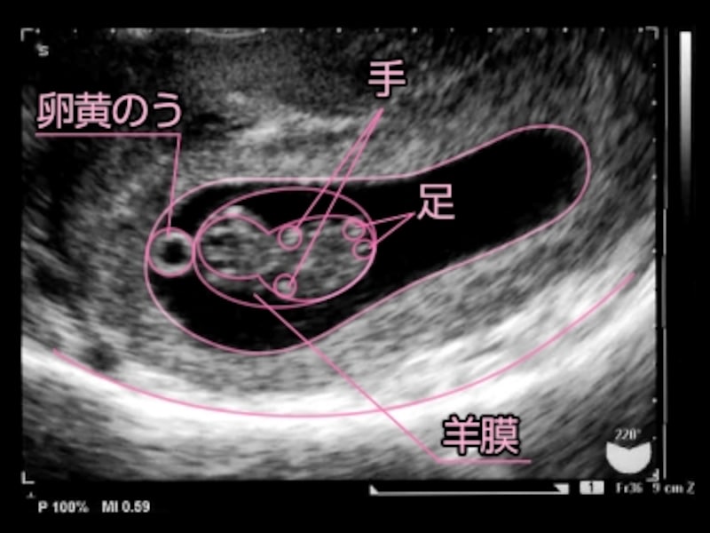妊娠9週目（9w,妊娠九週,9w0d,9w1d,9w2d,9w3d,9w4d,9w5d,9w6d）胎児のエコー写真・超音波写真