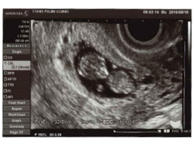 妊娠10週目（10w）の胎児のエコー写真・超音波写真