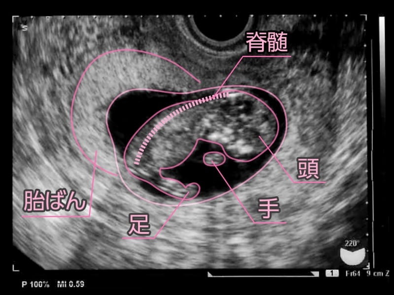 妊娠11週目（11w）の胎児のエコー写真・超音波写真　頭殿長（CRL）は44～60mm