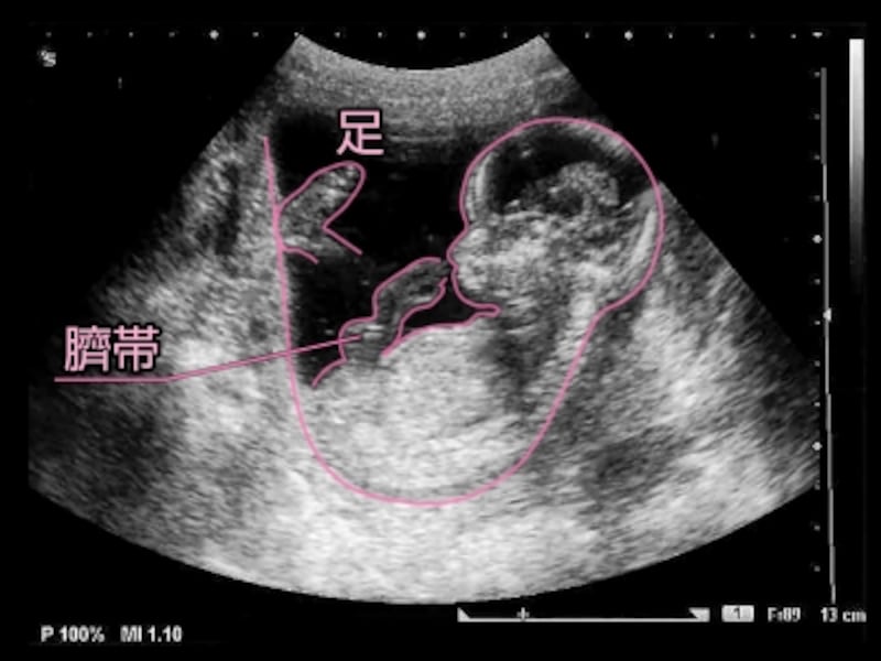妊娠14週目（14w　十四週）、胎児のエコー写真・超音波写真