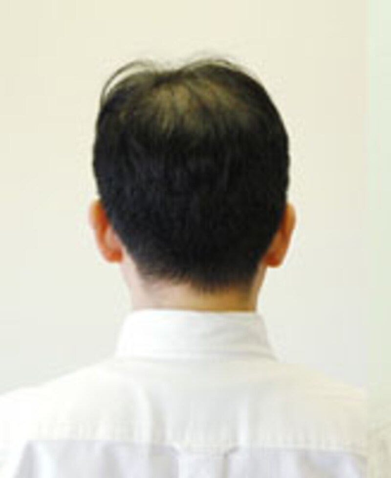 薄毛さんイメージ