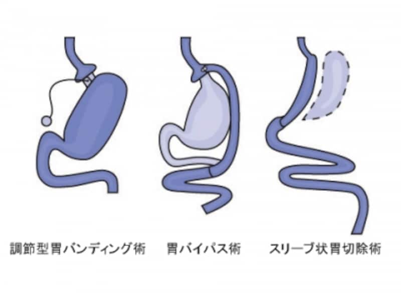 手術 バンディング