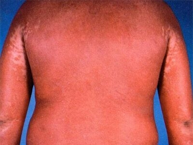 乾癬紅皮症の原因は何ですか?