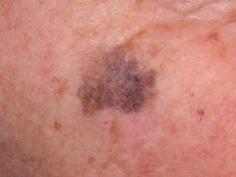 足の黒色腫の原因は何ですか?