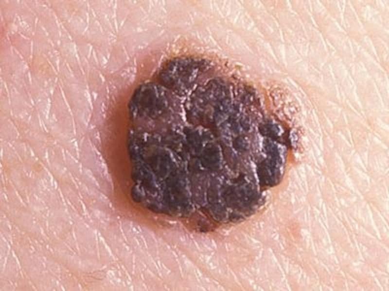 表在性黒色腫を患った人の今後の見通しはどうなりますか?