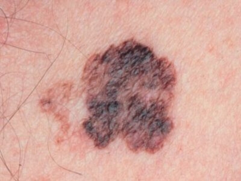 黒色腫は他にどこに転移しますか?