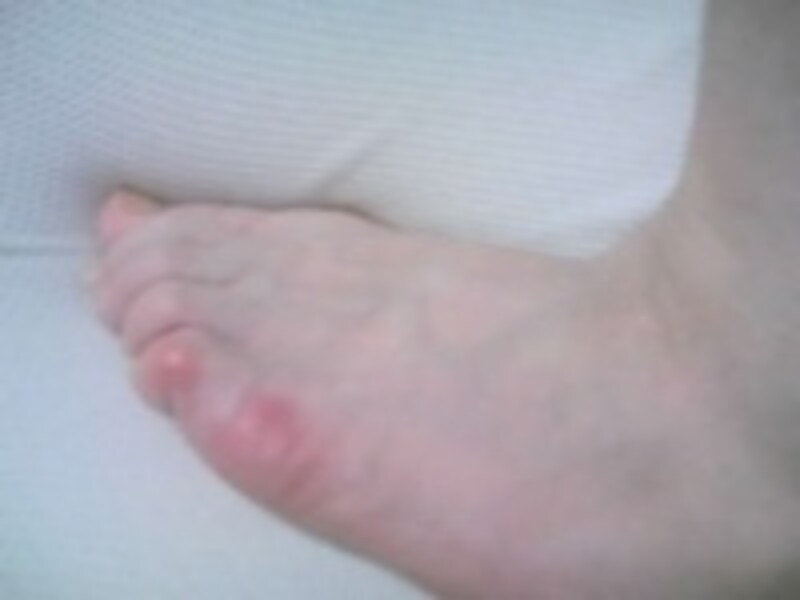 足の指が靴の中で押されて痛くなることがあります