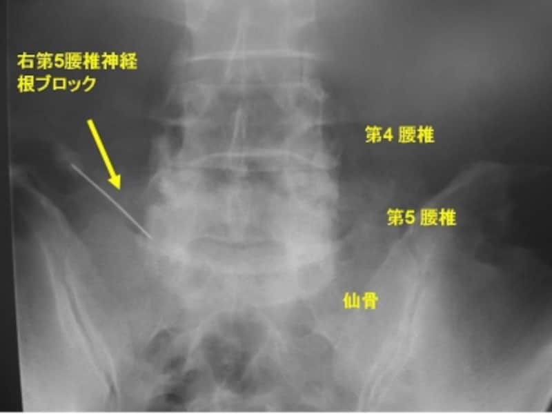 右第5腰椎神経根ブロック