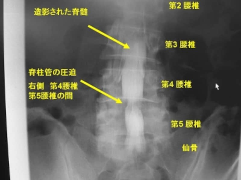 脊髄造影単純X線写真