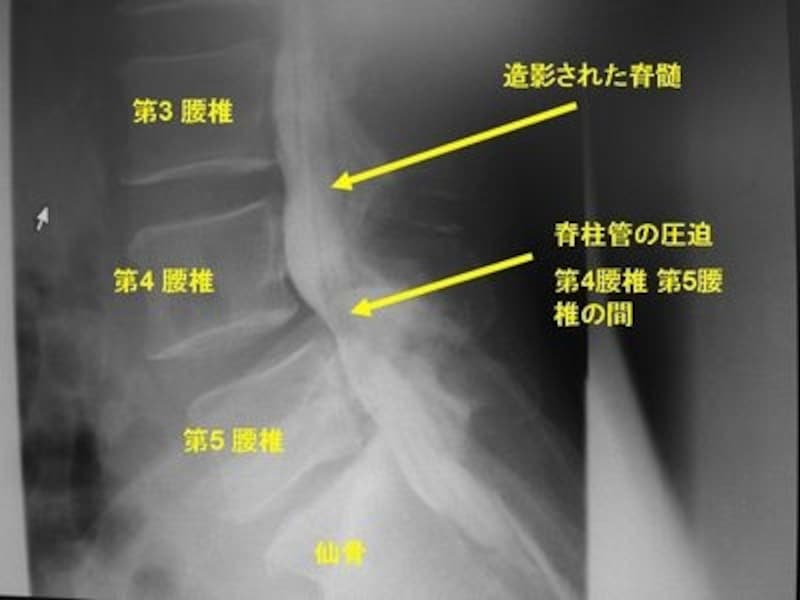 脊髄造影X線写真