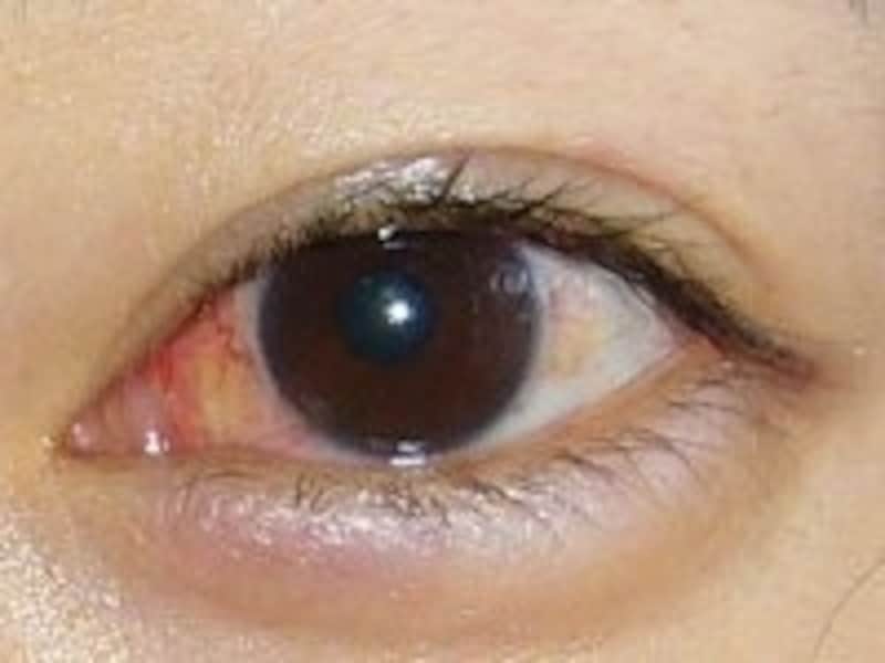 瞼裂斑