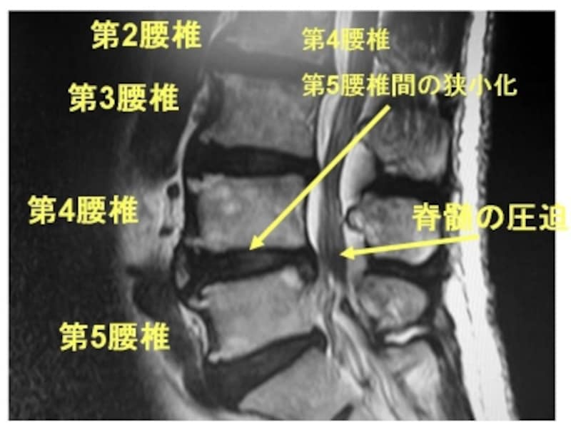 MRI
