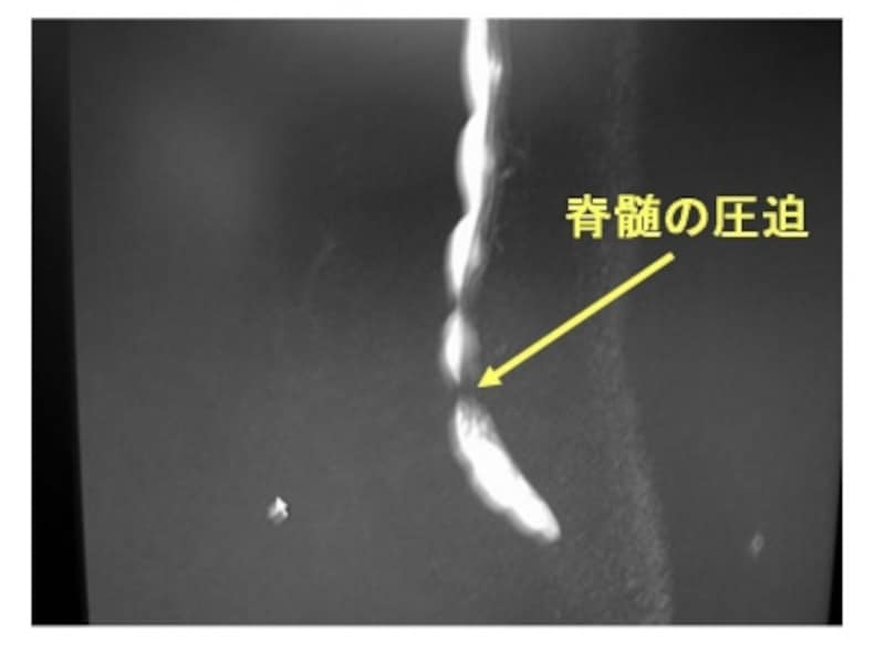 脊髄