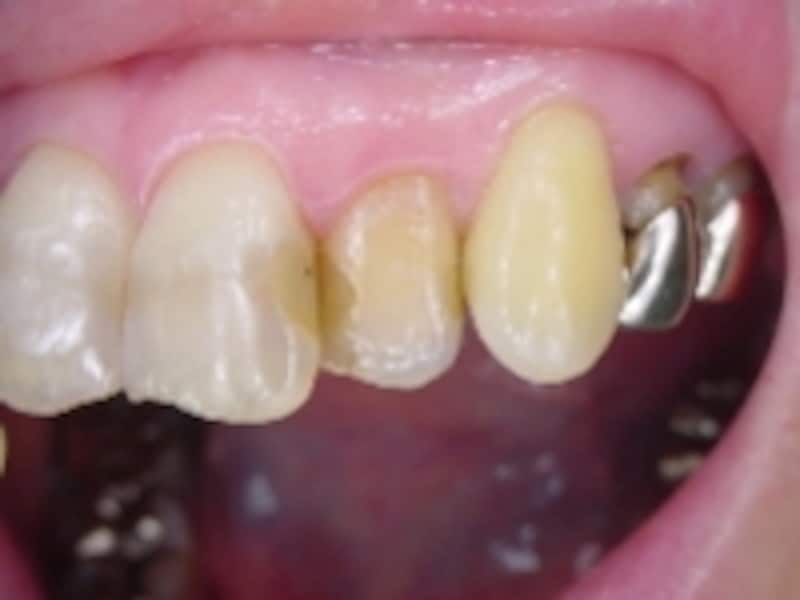 前歯の樹脂