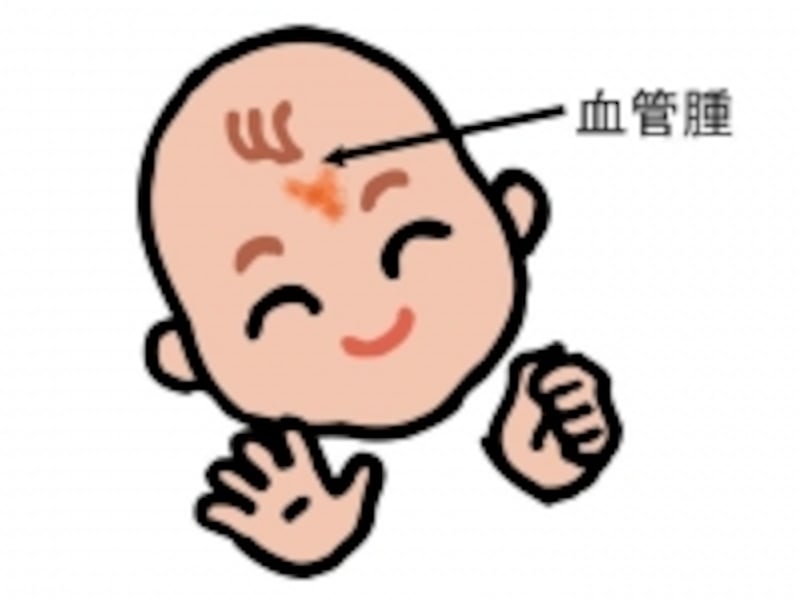 サーモンパッチ