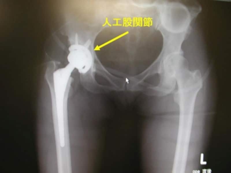 術後