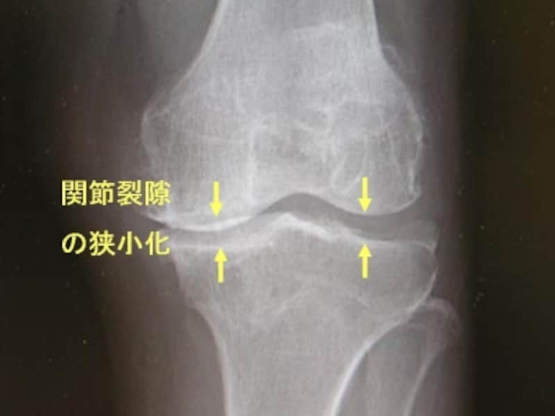 左膝関節単純X線像