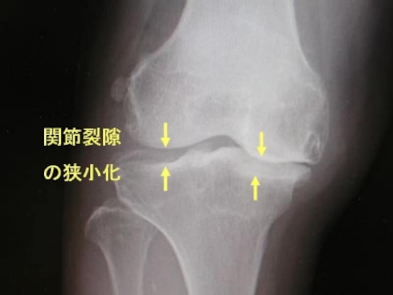 右膝関節単純X線像