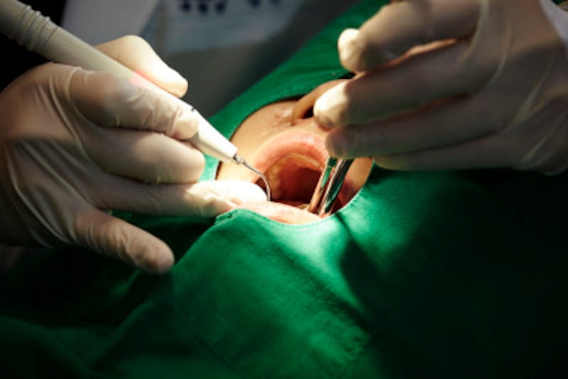 歯の手術など、口の中の手術