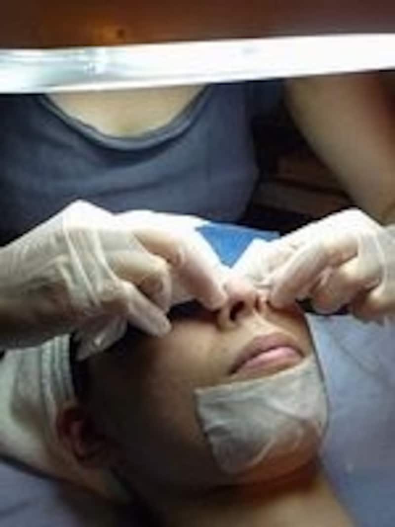 エクストラクション