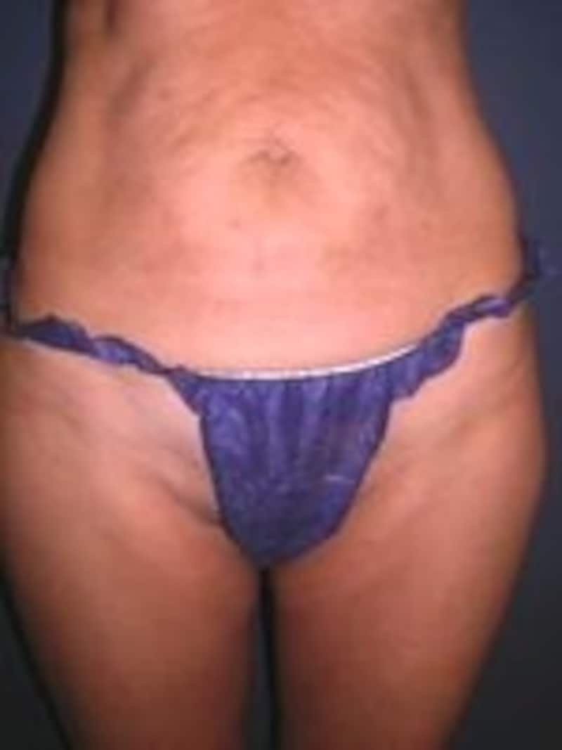 ボディビフォア