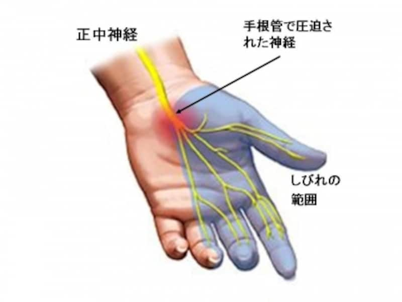 手のしびれの症状から考えられる病気とは 骨 筋肉 関節の病気 All About