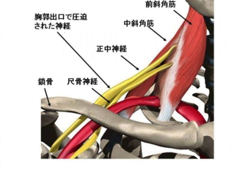 胸郭出口症候群